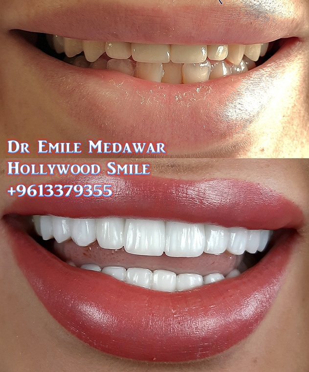 قبل وبعد فينيرز إيماكس